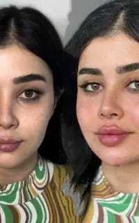آموزش و تزریق ژل و بوتاکس،تزریق چربی،لیفت نخ