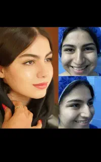 عمل زیبایی در بیمارستان بینی کاشت مو.بلفارو.بوتاکس