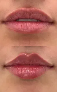 جشنواره فیلر و مزوژل بابل(پزشک متخصص از تهران)