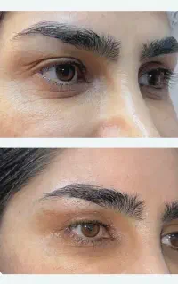 بلفاروپلاستی چشم گربه ای ارومیه