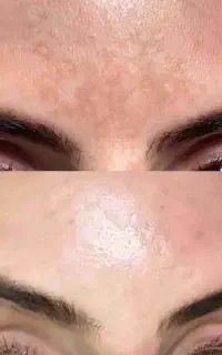 لیزر تک جلسه کک مک  خال تتو پوست کر ه ای