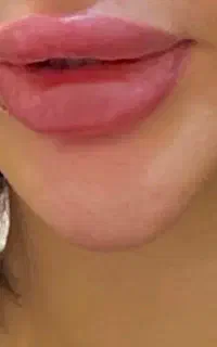 اف ویژه تزریق ژل و بوتاکس برای اقا و‌خانم