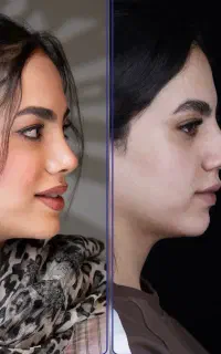 عمل بینی لیزری در شیراز/بدون کبودی+وام