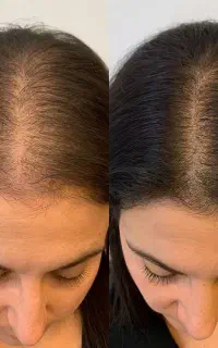 تخفیف ویژه پی آر پی مزوتراپی بوتاکس کاشت مو