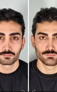 تزریق فیلر،بوتاکس،جوانساز،لیزر،مزو تراپی