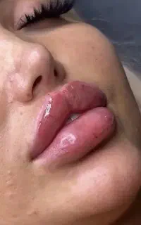 جشنوااره تزریق چربی باسن تخلیه غبغب تزریق ژل