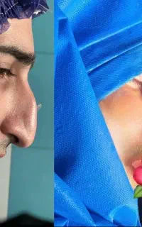 جراحی بینی ۳۸میلیون تومان