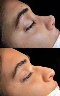 عمل بینی و زیبایی کل بدن و صورت با شرایط اقساطی