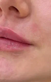 بوتاکس و ژل تخصصی با مواد اصل و تخفیف ویژه