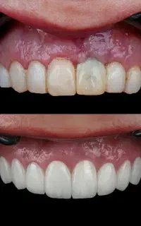 دندانپزشکی اقساطی ایمپلنت عصبکشی روکش لمینت و...