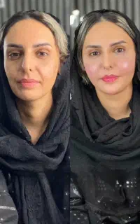 زیبایی و لیف و جوانسازی در یک جلسه/فیلر/کانتورینگ