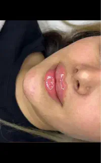 آف ویژه خدمات تخصصی ژل و بوتاکس