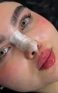فیلرلب گونه چانه فول فیس وبوتاکس