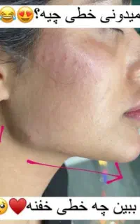 ژل فیلر بوتاکس جوانساز