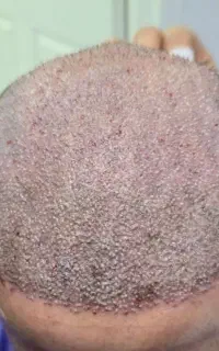 کاشت مو و ابروی آوین