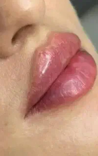 تزریق ژل .بوتاکس .انزیم بینی .مزوژل جوانساز