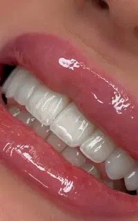 ایمپلنت با وام و اقساط،مشاوره رایگان
