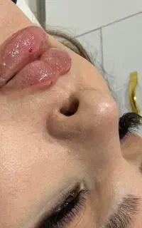 تخفیف ویژه امروز تزریق ژل و بوتاکس وساکشن (ققنوس