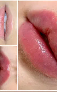 ژل بوتاکس آنزیم مزوتراپی چالگونه پیرسینگ توسط پزشک