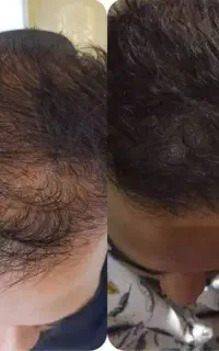 پیشگیری از ریزش مو با محصولات سلامت محور