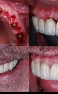 اقساط 12 ماهه دندانپزشکی ایمپلنت عصب کشی وترمیم..