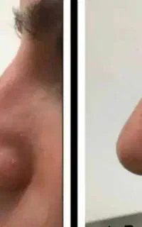 محصولات کوچک کننده و فرم دهنده بینی در منزل