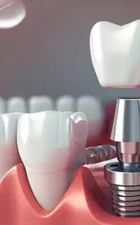 اف ویژه دندان ایمپلنت 10 کامپوزیت 1 (در کرمانشاه)