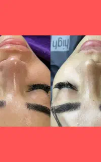 پاکسازی و فیشال صورت