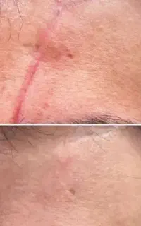 لیزر جای بخیه،جای جوش،ترک پوستی
