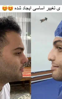 جراحی بینی توسط دکتر امیر حسین اسدالله پور
