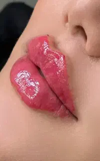 مدل ژل لب بوتاکس فیلر مزو مزوژل انزیم توسط پزشک۸۵۰