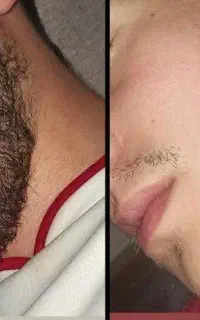 ریزش سکه ای ریش سبیل کوسه درمانی