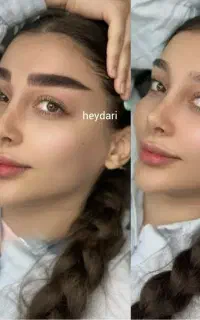 فیبروز ابرو فقط هزینه مواد