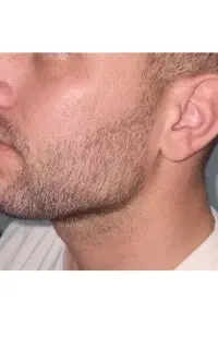 تزریق بوتاکس،فیلر و prp و مزوتراپی