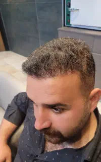 کاشت مو اقساطی