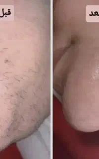حذف دائمی موهای زائدسفید با الکترولیز