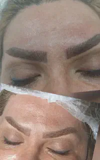 میکروبیلدینگ سه بعدی و کوچک کردن بینی بدون جراحی