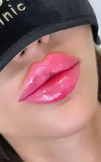 جشنواره زیبایی تزریق ژل،بوتاکس،هایفو تراپی تخصصی