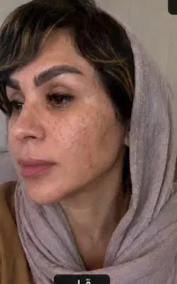 لک  پوستت رو با روش غلط درمان نکن(راه حل اصولی)