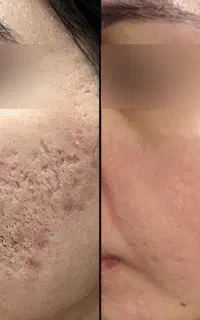 آف اقتصادی برای برای جوانسازی و لیفت ملایم پوست