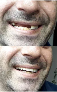 دندان مصنوعی( دنچر)،تک دندانی و کامل.