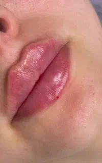 تخفیف ویژه خدمات فیلر فیلربادی بوتاکس مزوتراپی