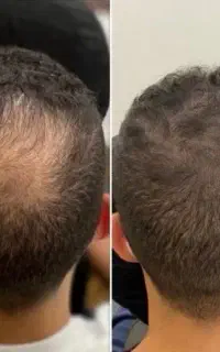 تتو اسکالپ کف سر