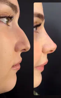 بدون جراحی بینی‌تو عملی کن تک جلسه توسط پزشک