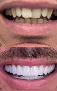 کامپوزیت جنس درجه یک با قیمت مناسب