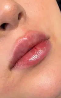 ژل لب روسی با تکنیکِ لومِن قلبی دکتر چالشی نچرال