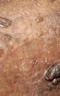 حذف کامل و ریشه ای hpv و زگیل