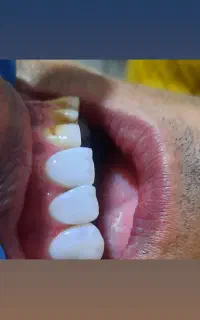 ایمپلنت ساخت کره(کاشت دندان)کلیه خدمات دندانپزشکی