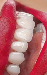تخفیف ویژه کامپوزیت دندان .ایمپلنت دندانپزشکی. عصب