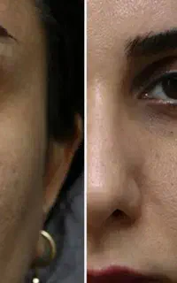 جوانسازی و لیفت حرفه‌ای پوست